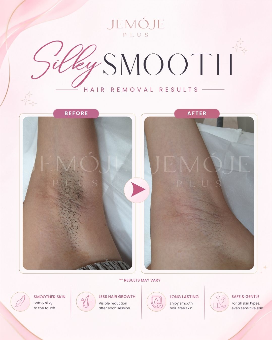SPECTRA 4 Hair Removal Before & After SPECTRA 4 Hair Removal before and after result 1 at JEMOJE Plus Mid Valley Kuala Lumpur