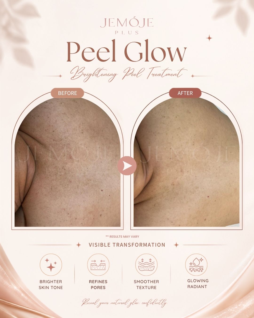 Peel Glow Treatment Before & After Peel Glow Treatment before and after result 1 at JEMOJE Plus Mid Valley Kuala Lumpur