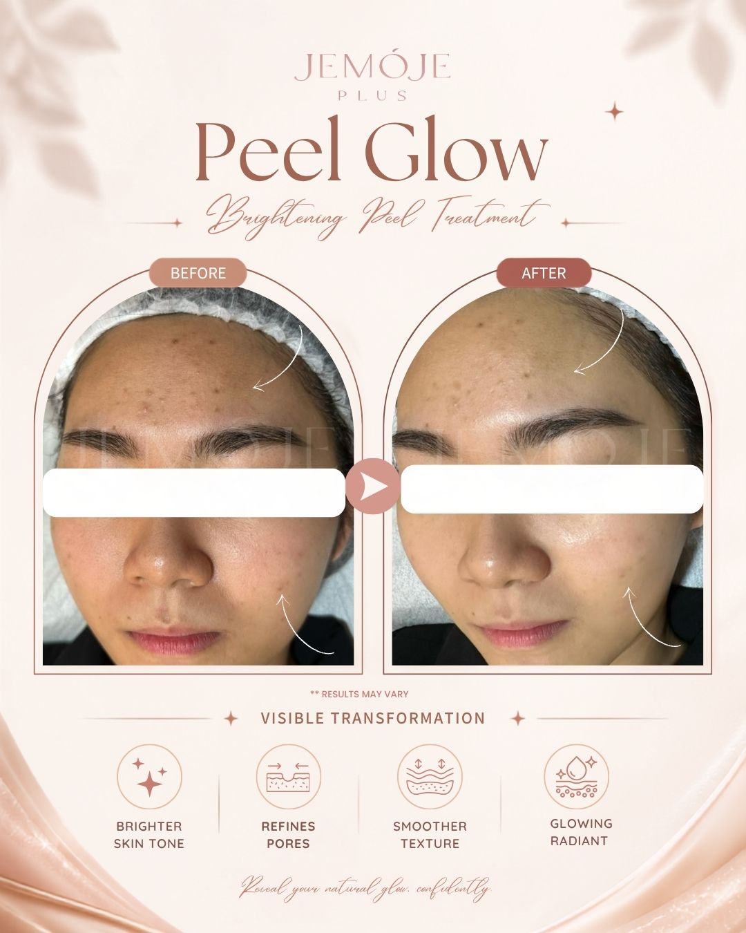 Peel Glow Treatment Before & After Peel Glow Treatment before and after result 2 at JEMOJE Plus Mid Valley Kuala Lumpur