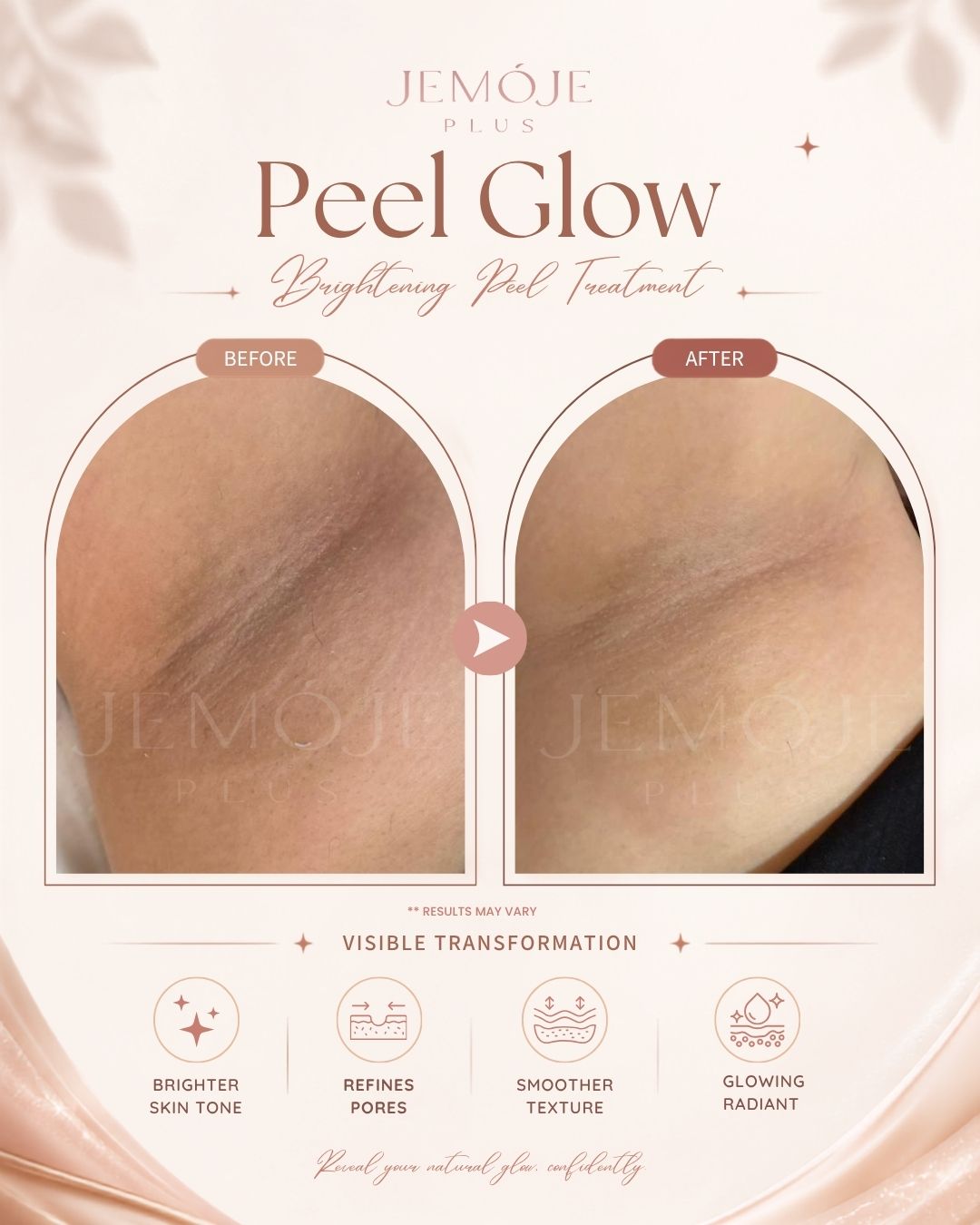 Peel Glow Treatment Before & After Peel Glow Treatment before and after result 3 at JEMOJE Plus Mid Valley Kuala Lumpur