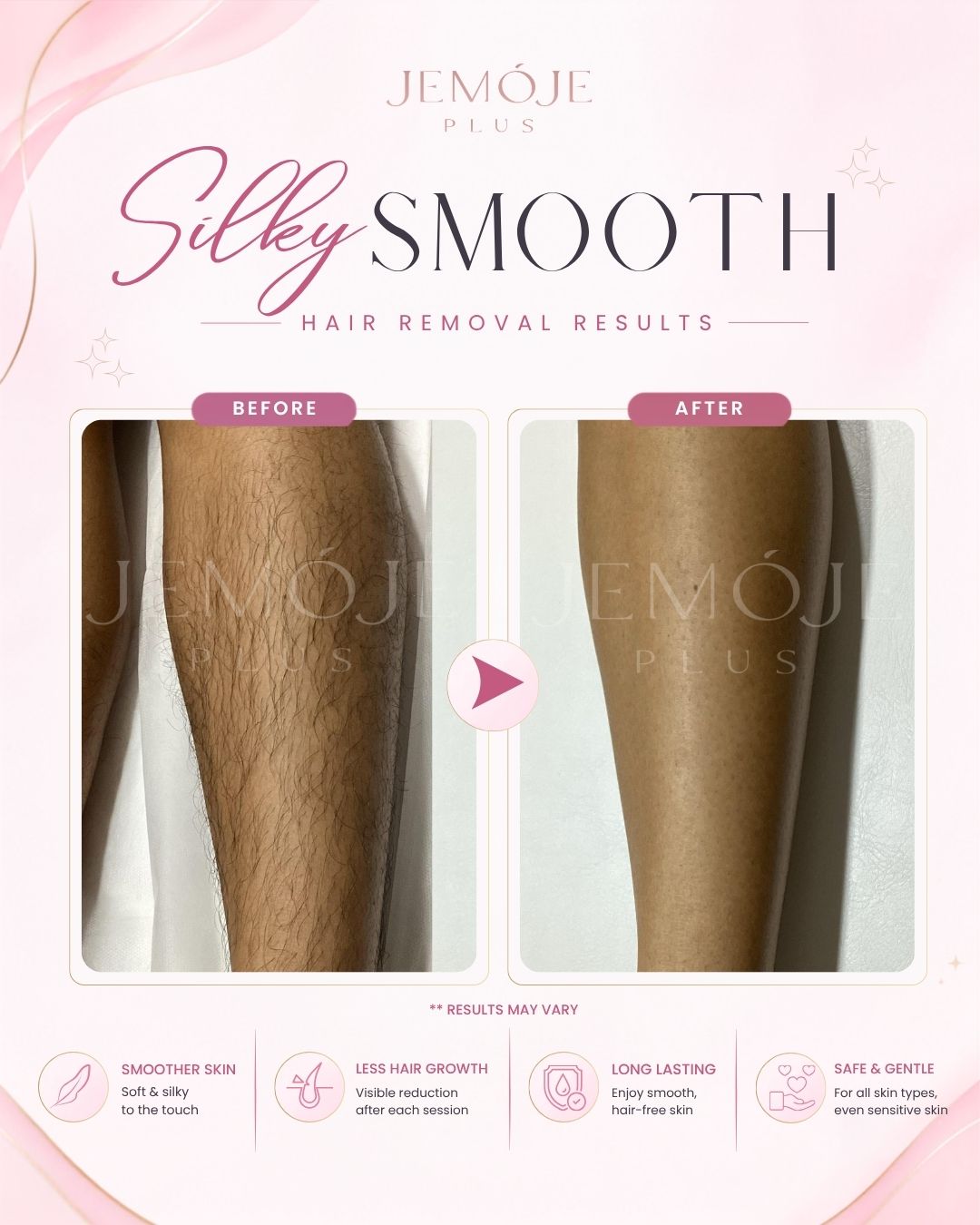 SPECTRA 4 Hair Removal Before & After SPECTRA 4 Hair Removal before and after result 2 at JEMOJE Plus Mid Valley Kuala Lumpur