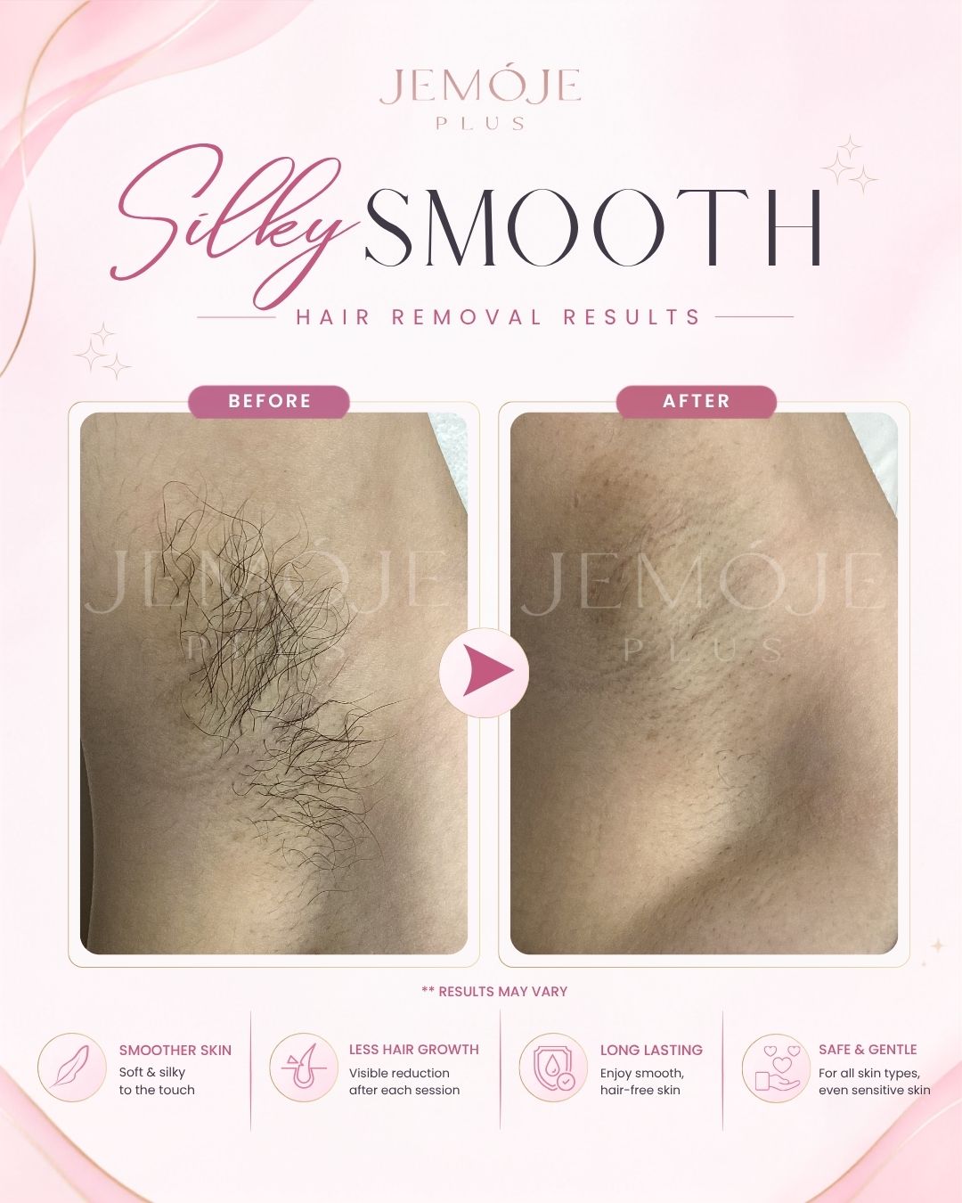 SPECTRA 4 Hair Removal Before & After SPECTRA 4 Hair Removal before and after result 3 at JEMOJE Plus Mid Valley Kuala Lumpur