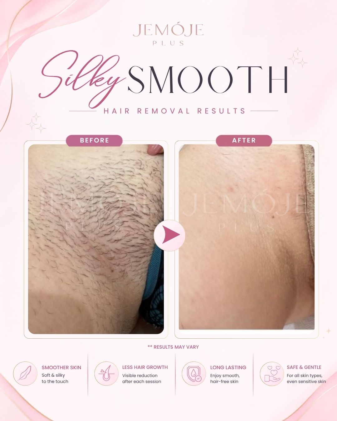 SPECTRA 4 Hair Removal Before & After SPECTRA 4 Hair Removal before and after result 4 at JEMOJE Plus Mid Valley Kuala Lumpur