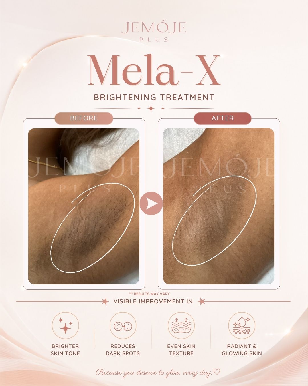Mela-X Skin Brightening Before & After Mela-X Skin Brightening before and after result 1 at JEMOJE Plus Mid Valley Kuala Lumpur