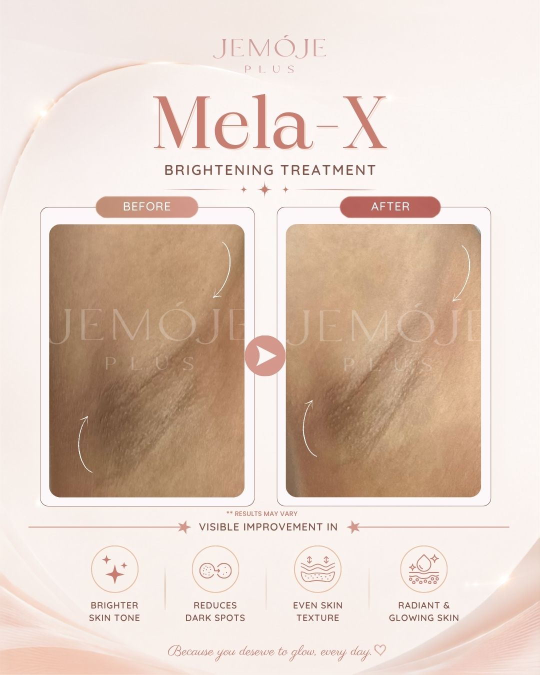 Mela-X Skin Brightening Before & After Mela-X Skin Brightening before and after result 2 at JEMOJE Plus Mid Valley Kuala Lumpur