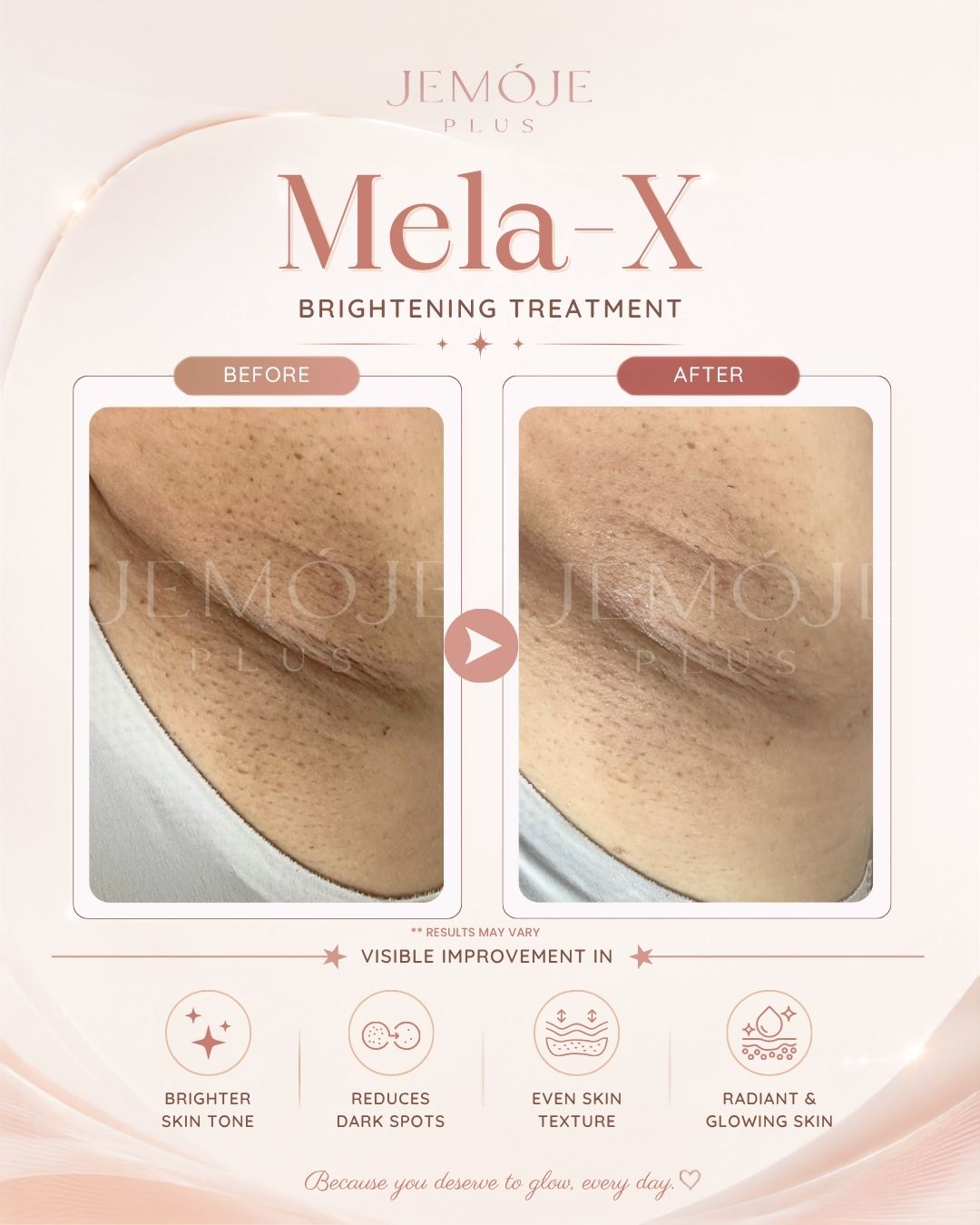 Mela-X Skin Brightening Before & After Mela-X Skin Brightening before and after result 3 at JEMOJE Plus Mid Valley Kuala Lumpur